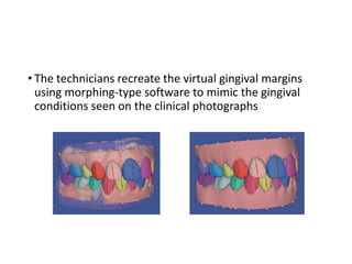 • The technicians recreate the virtual gingival margins
using morphing-type software to mimic the gingival
conditions seen on the clinical photographs
 