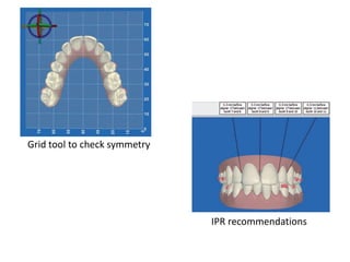 Grid tool to check symmetry
IPR recommendations
 