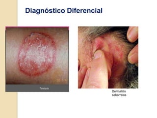 Diagnóstico Diferencial
Dermatitis
seborreica
 