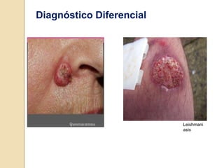 Leishmani
asis
Diagnóstico Diferencial
 