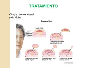TRATAMIENTO
Cirugía convencional
y de Mohs
 