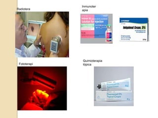 Radiotera
pia
Inmunoter
apia
Fototerapi
a
Quimioterapia
tópica
 