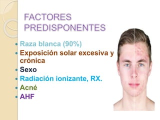  Raza blanca (90%)
 Exposición solar excesiva y
crónica
 Sexo
 Radiación ionizante, RX.
 Acné
 AHF
 