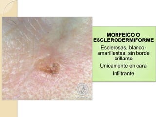 MORFEICO O
ESCLERODERMIFORME
Esclerosas, blanco-
amarillentas, sin borde
brillante
Únicamente en cara
Infiltrante
 