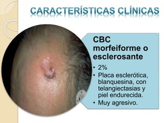 CBC
morfeiforme o
esclerosante
• 2%
• Placa esclerótica,
blanquesina, con
telangiectasias y
piel endurecida.
• Muy agresivo.
 