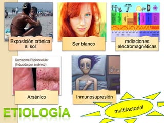 Exposición crónica
al sol
Ser blanco
radiaciones
electromagnéticas
Arsénico Inmunosupresión
 