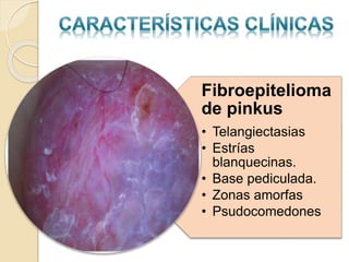 Fibroepitelioma
de pinkus
• Telangiectasias
• Estrías
blanquecinas.
• Base pediculada.
• Zonas amorfas
• Psudocomedones
 