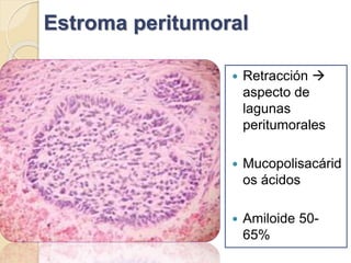 Estroma peritumoral
 Retracción 
aspecto de
lagunas
peritumorales
 Mucopolisacárid
os ácidos
 Amiloide 50-
65%
 