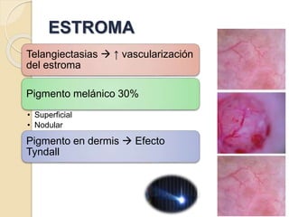 ESTROMA
Telangiectasias  ↑ vascularización
del estroma
Pigmento melánico 30%
• Superficial
• Nodular
Pigmento en dermis  Efecto
Tyndall
 