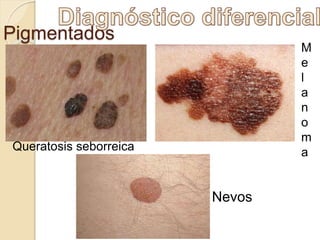 Pigmentados
Queratosis seborreica
 Nevos
M
e
l
a
n
o
m
a
 