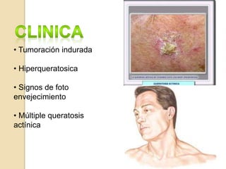 • Tumoración indurada
• Hiperqueratosica
• Signos de foto
envejecimiento
• Múltiple queratosis
actínica
 