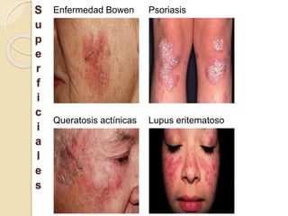 S
u
p
e
r
f
i
c
i
a
l
e
s
Enfermedad Bowen Psoriasis
Queratosis actínicas Lupus eritematoso
 