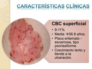 CBC superficial
• 9-11%
• Media 56.8 años.
• Placa eritemato -
escamosa, tipo
psoriasiforme.
• Crecimiento lento y
tiende a la
ulceración.
 