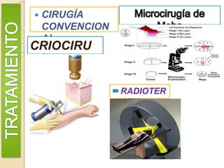  CIRUGÍA
CONVENCION
AL
CRIOCIRU
GÍA
RADIOTER
APIA
 