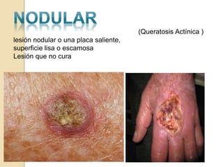 lesión nodular o una placa saliente,
superficie lisa o escamosa
Lesión que no cura
(Queratosis Actínica )
 