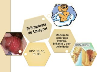 HPV: 16, 18,
31, 33.
Macula de
color rojo
intenso,
brillante y bien
delimitada
 