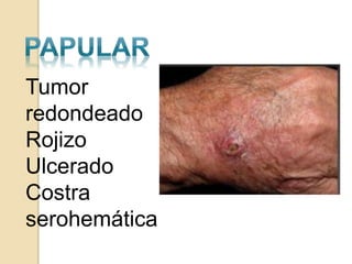 Tumor
redondeado
Rojizo
Ulcerado
Costra
serohemática
 