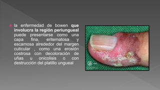  la enfermedad de bowen que
involucra la región periungueal
puede presentarse como una
capa fina, eritematosa y
escamosa alrededor del margen
cuticular , como una erosión
costrosa con decoloración de
uñas u onicolisis o con
destrucción del platillo ungueal
 