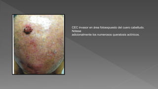 CEC invasor en área fotoexpuesto del cuero cabelludo.
Nótese
adicionalmente los numerosos queratosis actínicos.
 