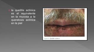  la queilitis actínica
es el equivalente
en la mucosa a la
queratosis actínica
en la piel
 