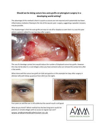 Should we be doing suture-less auto-grafts on pterygium surgery in a
developing world setting?
The advantage of this method is that it is quick as sutures are not required and it potentially has fewer
inflammatory mediators flowing to the site of the wound, post- surgery, suggesting a speedier recovery
may be possible.
The disadvantage is that the auto-grafts are easy to rub off or displace as seen here in a case this year
where a patient rubbed his eye two days after surgery.
The use of a bandage contact lens would reduce the number of displaced suture-less grafts. However
this may not be ideal in a rural villages unless you have someone who can remove the contact lens after
a few weeks.
When done well the suture less graft can look very good as in this example ten days after surgery in
2011(on left) with follow up picture from 2015 (on the right).
Four years on and the scar is still visible but the overall result is still good.
What do you think?? Which method has the best long term results for
patients in remote villages with no access to regular eye care?
www.andeanmedicalmission.co.uk
 