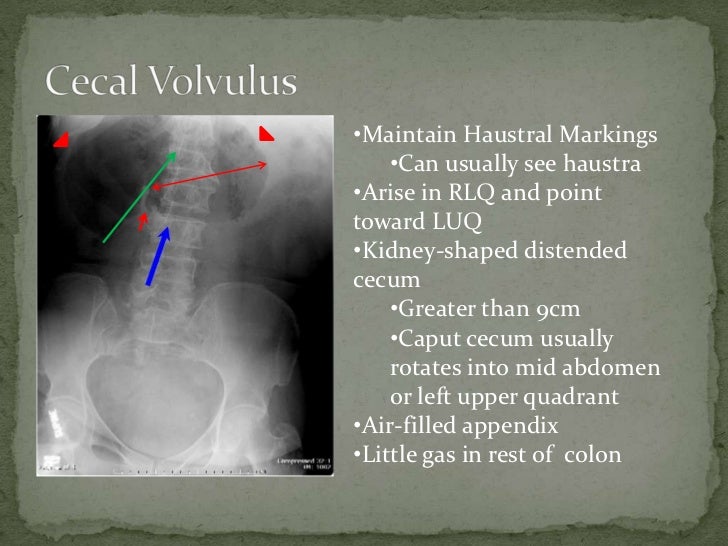 Cecal volvulus