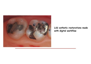 LiSi esthetic restorations made
with digital workflow
 