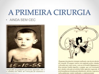 A PRIMEIRA CIRURGIA
• AINDA SEM CEC
 