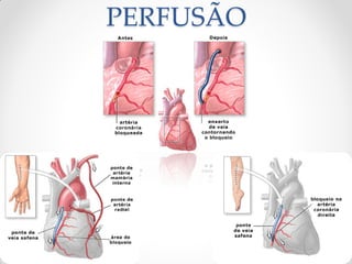 PERFUSÃO
 