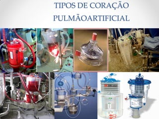 TIPOS DE CORAÇÃO
PULMÃOARTIFICIAL
 