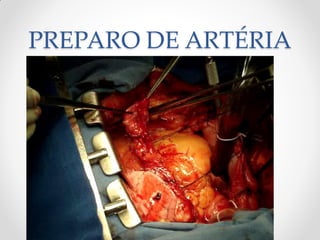 PREPARO DE ARTÉRIA
 