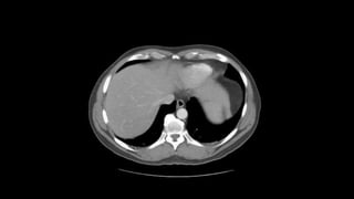 Absccess Triphasic Ct Scan Abdominal CT scan, Triphasic CT scan, Abdominal Anatomy and ...