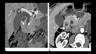 Absccess Triphasic Ct Scan Abdominal CT scan, Triphasic CT scan, Abdominal Anatomy and ...