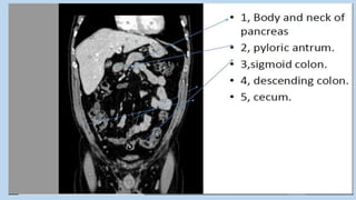 Absccess Triphasic Ct Scan Abdominal CT scan, Triphasic CT scan, Abdominal Anatomy and ...