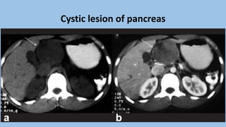 Absccess Triphasic Ct Scan Abdominal CT scan, Triphasic CT scan, Abdominal Anatomy and ...
