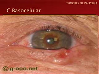 C.Basocelular
TUMORES DE PÁLPEBRA
 