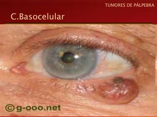 C.Basocelular
TUMORES DE PÁLPEBRA
 