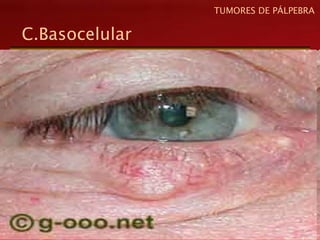 C.Basocelular
TUMORES DE PÁLPEBRA
 