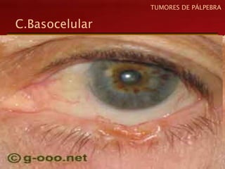 C.Basocelular
TUMORES DE PÁLPEBRA
 