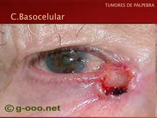 C.Basocelular
TUMORES DE PÁLPEBRA
 