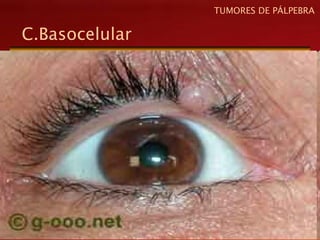 C.Basocelular
TUMORES DE PÁLPEBRA
 