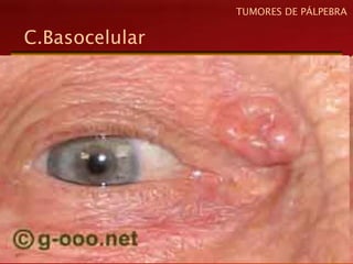 C.Basocelular
TUMORES DE PÁLPEBRA
 