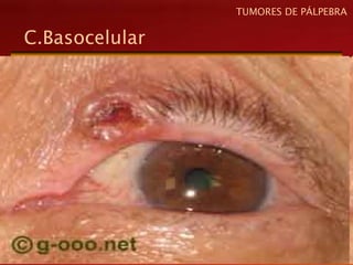 C.Basocelular
TUMORES DE PÁLPEBRA
 