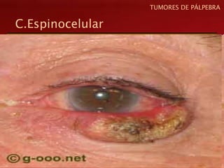 C.Espinocelular
TUMORES DE PÁLPEBRA
 