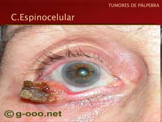 C.Espinocelular
TUMORES DE PÁLPEBRA
 