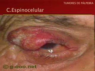 C.Espinocelular
TUMORES DE PÁLPEBRA
 