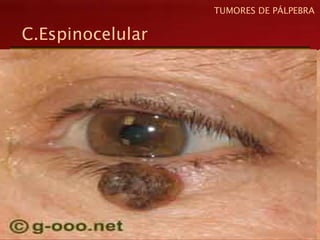 C.Espinocelular
TUMORES DE PÁLPEBRA
 