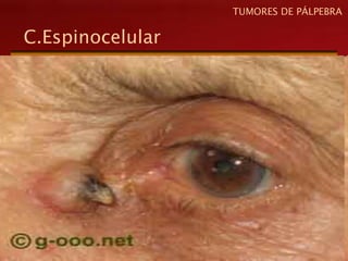 C.Espinocelular
TUMORES DE PÁLPEBRA
 