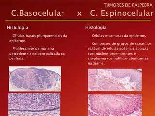Histologia
Células basais pluripotenciais da
epiderme.
Proliferam-se de maneira
descedente e exibem paliçada na
periferia.
C.Basocelular x C. Espinocelular
TUMORES DE PÁLPEBRA
Histologia
Células escamosas da epiderme.
Compostos de grupos de tamanhos
variável de células epiteliais atípicas
com núcleos proeminentes e
citoplasma eosinofilicos abundantes
na derme.
 