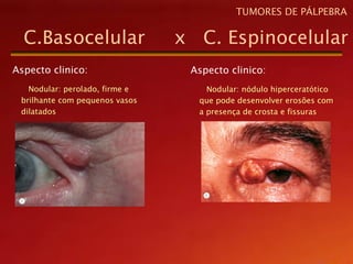 Aspecto clinico:
Nodular: perolado, firme e
brilhante com pequenos vasos
dilatados
C.Basocelular x C. Espinocelular
TUMORES DE PÁLPEBRA
Aspecto clinico:
Nodular: nódulo hiperceratótico
que pode desenvolver erosões com
a presença de crosta e fissuras
 